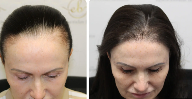 Top Factors to Consider Before Getting a Hair Transplant